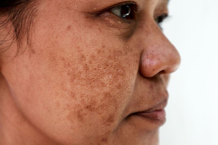 Hyperpigmentation هایپرپیگمنتیشن